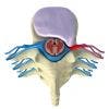Hernia Discal. Qué es, causas y tipos de lesiones del disco intervertebral