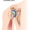 ¿Qué es la tendinitis del bíceps?