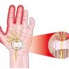 Sindrome del túnel carpiano. Ejercicios y tratamiento recomendado