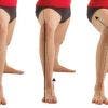 Valgo de Rodilla, Qué es y cual es su tratamiento o corrección 