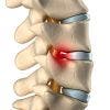 ¿Qué es una hernia discal lumbar? Síntomas, causas y tratamiento