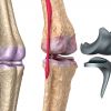 Rehabilitación de una prótesis de rodilla o artroplastia de rodilla. Consejos, ejercicios y fases de tratamiento