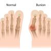 ¿Qué es un Juanete o Hallux Valgus?