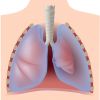 Neumotorax, clínica y clasificación