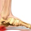 Fascitis plantar ¿Seguro? Posiblemente no lo sea  