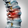 Hernia discal lumbar, ¿tratamiento fisioterápico o tratamiento quirúrgico?