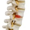 Causas, diagnóstico y tratamiento integrativo para la hernia discal lumbar 