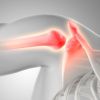 Bursitis, Tendinitis y Síndrome Subacromial: ¿Cómo Diferenciarlos y Tratarlos Correctamente?