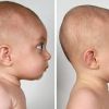 Plagiocefalia y tortícolis en bebés recién nacidos