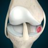 Diagnóstico de la rotura de menisco. Cómo saber si la padeces.