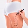 Abdominoplastia o Dermolipectomia. Qué es y cómo puede ayudar la fisioterapia.