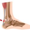Rotura del tendón de Aquiles. Causas, síntomas y tratamiento