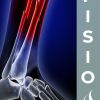 FRACTURA de TIBIA y PERONÉ: Tratamiento desde la fase de INMOVILIZACIÓN
