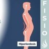 5 ejercicio para corregir la híperlordosis lumbar