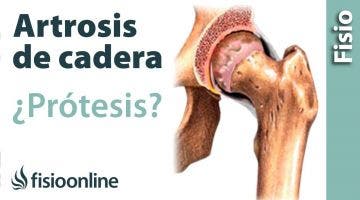 artrosis o desgaste de cadera,  cuándo operarse y pornerse una prótesis