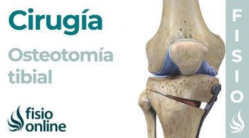 OSTEOTOMÍA TIBIAL: Técnica de la artrosis de rodilla sin prótesis