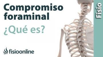 Compromiso foraminal o del neuroforamen. ¿Qué es?