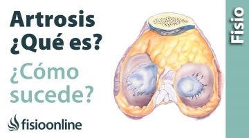 Artrosis. Como sucede y cuales son sus causas.