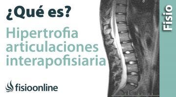 Hipertrofia de las articulaciones interapofisarias o facetarias. ¿Qué es?