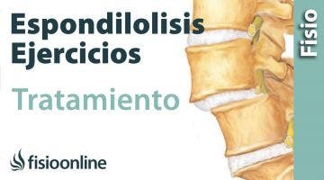 Espondilolisis y espondilolistesis. Tratamiento con ejercicios, auto masajes y estiramientos