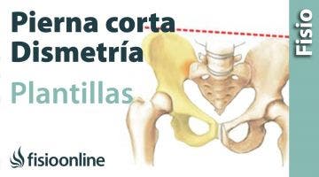 Plantillas para dismetría o pierna corta. Un error garrafal