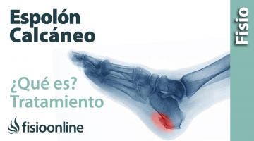 7# Espolón calcaneo en el talón. Qué es, causas, síntomas y tratamiento.