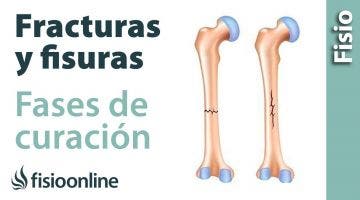 43# ¿Qué es una fractura y una fisura y cuales son sus fases de curación?