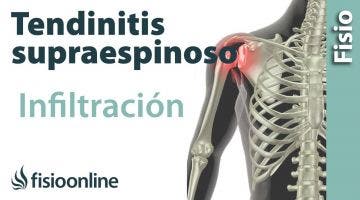 Tendinitis de hombro o supraespinoso infiltraciones