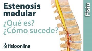 Estenosis del canal medular. ¿Qué es y cómo sucede?