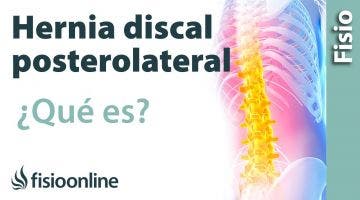 Protrusión o Hernial discal posterolateral o posteromedial. ¿Qué es?