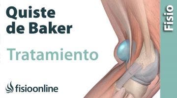 Cómo tratar el Quiste de Baker. Guía para pacientes