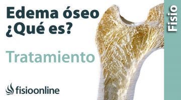 Edema óseo - Qué es, causas y tratamiento