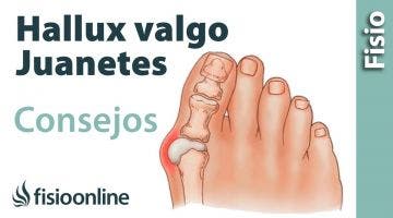 Hallux Valgus o juanete. Consejos y tratamiento con ejercicios, auto masajes y estiramientos