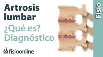 Artrosis lumbar - Qué es y cómo se diagnostica en radiografías