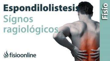 Espondilolisis y Espondilolistesis - Signos radiológicos.