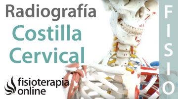 Costilla cervical - Qué es y cómo se diagnostica por radiografía