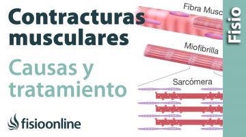 Contractura muscular - Qué es y cómo sucede