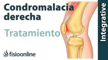 Tratamiento de la condromalacia rotuliana derecha