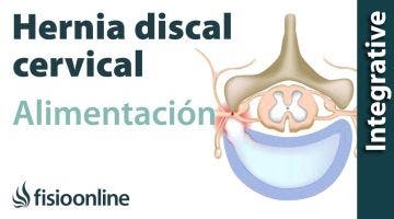 Hernia discal cervical Izquierda. Alimentación nutrición y modificaciones en la dieta.