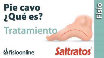 Pie Cavo o arqueado. Qué es, causas, síntomas y tratamiento.
