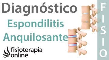 Espondilitis anquilosante - Qué es, diagnóstico y tratamiento