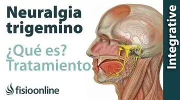 Neuralgia del trigémino - Qué es, causas y tratamiento