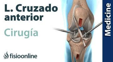 CIRUGÍA del LIGAMENTO CRUZADO ANTERIOR