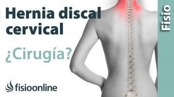 hernia discal cervical: cuándo optar por la cirugía u operación quirúrgica