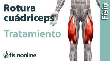 Rotura de fibras del cuádriceps. Tratamiento con ejercicios, auto masajes y estiramientos