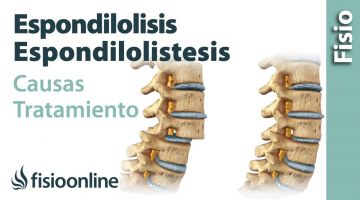 39,40# Espondilolisis y Espondilolistesis. Qué es, causas, síntomas y tratamiento.