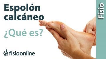 ¿Qué es el espolón calcáneo?