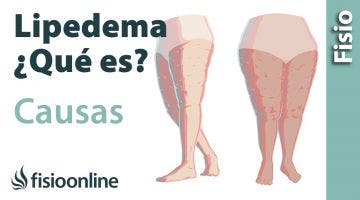 LIPEDEMA, qué es y por qué se produce