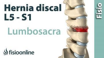 Hernia discal lumbar entre la L5 y S1 o quinta vértebra lumbar y el sacro