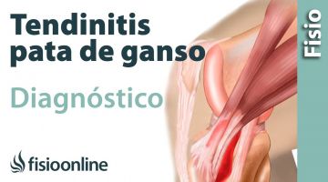 Cómo saber si tengo tendinitis de la pata de ganso